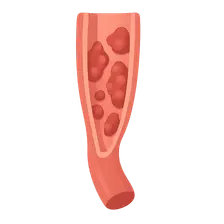 Medium vessel vasculitis