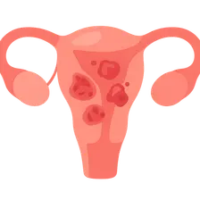 Postpartum Infections