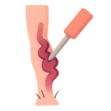 Venous insufficiency and varicose vein treatment