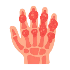 Psoriatic Arthritis