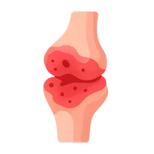 Septic Arthritis