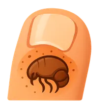 Tungiasis