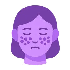 Systemic Lupus Erythematosus