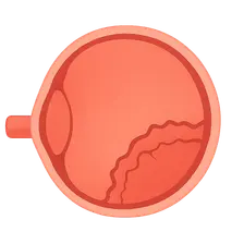 Retinopathy of Prematurity