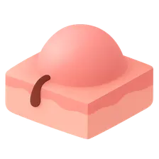 Benign Epithelial Tumors