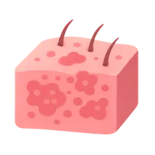 Candidiasis