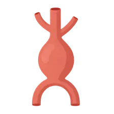 Aortic Aneurysms