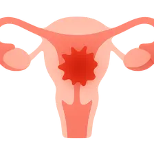 Acute Pelvic Pain