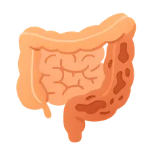 Inflammatory Bowel Disease