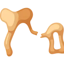 Traumatic Ossicular Disruption