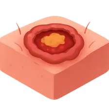 Ecthyma