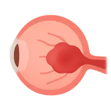 Papilledema