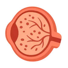 Diabetic Retinopathy