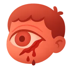 Pediatric Ocular Trauma