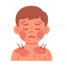 Atopic Dermatitis in Children