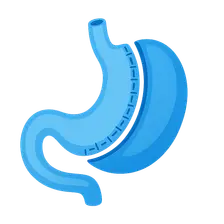 Sleeve Gastrectomy