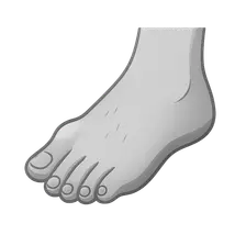 Hallux Valgus