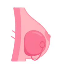 Tissue Expansion