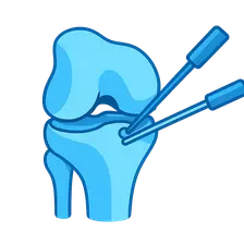 Knee Arthroscopy