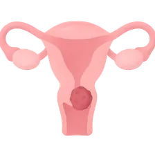 Cervical Cancer