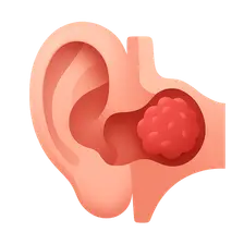 Glomus Tumors