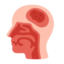 Intracranial Complications of Sinusitis