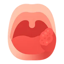 Oropharyngeal Carcinoma