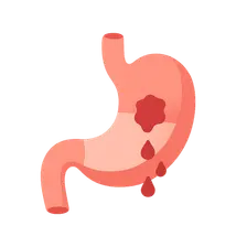 Gastrointestinal Bleeding