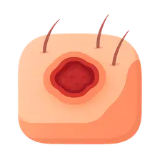 Leishmaniasis