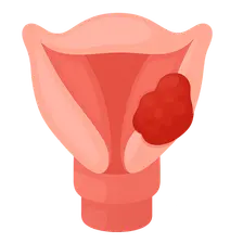 Laryngeal Cancer