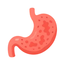Peritonitis