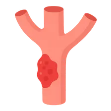Large vessel vasculitis
