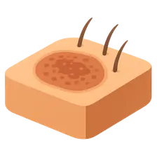 Dermatophytoses
