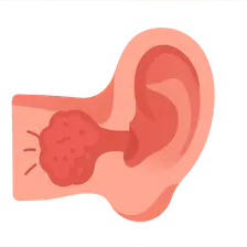 Malignant Otitis Externa