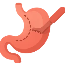 Gastric surgery procedures