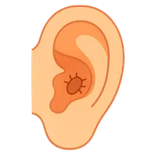 Foreign Bodies in the Ear