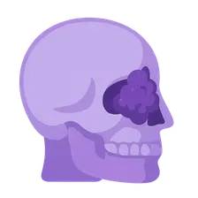Esthesioneuroblastoma
