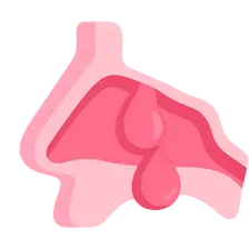 Nasal Polyposis