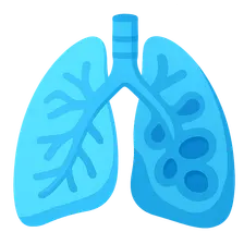 Bronchiectasis