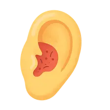 Otitis Externa