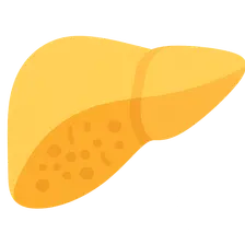 GSD type I (von Gierke disease)