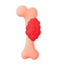 Bone Sarcomas