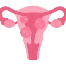 Uterine Fibroids