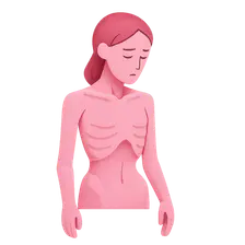 Anorexia Nervosa