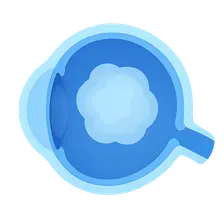 Congenital and Developmental Cataracts