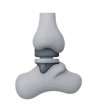 Ankle Arthroplasty