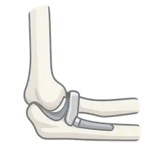 Elbow Arthroplasty