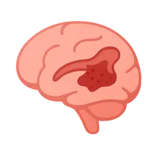 Intraventricular Hemorrhage