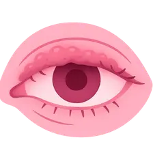 Blepharitis and Meibomian Gland Dysfunction