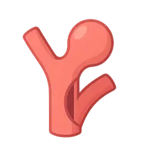 Aneurysms and Dissection